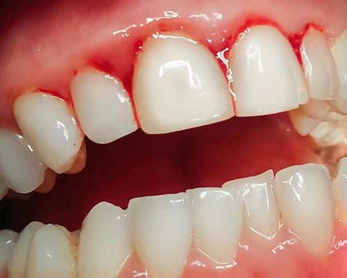Bleeding from the gums Alsundos Dental Complex